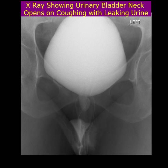 Urethra opens on coughing Urethra opens on coughing